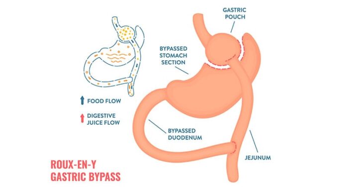 El bypass gástrico aumenta la remisión de la diabetes tipo 2, incluso con la recuperación de peso