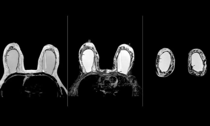 La resonancia magnética mamaria permite seleccionar pacientes que pueden omitir tratamientos como la radioterapia o la cirugía