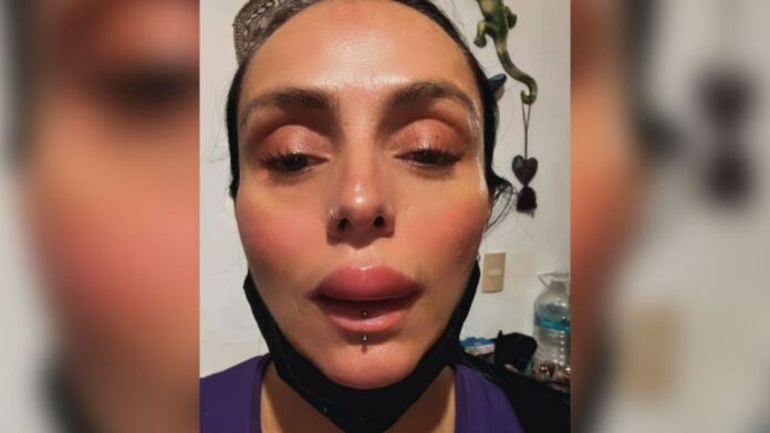 Ivonne Montero sufre una reacción alérgica y acaba con los labios hinchados: “Soy una Kardashian”