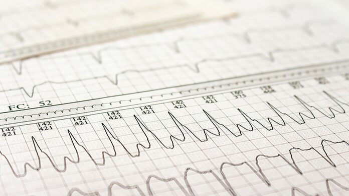 La insuficiencia cardíaca, no el accidente cerebrovascular, es la complicación más común de la FA