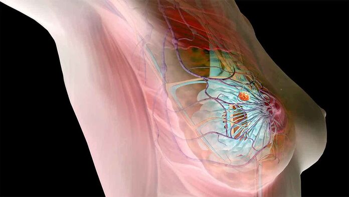 La resistencia impulsada por ESR1 a los inhibidores de CDK4/6 en el cáncer de mama frustrada por los SERD