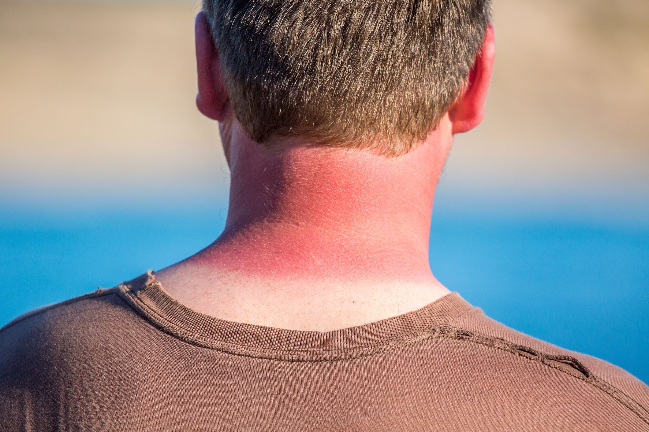 Cuello rojo quemado por demasiado sol Australia