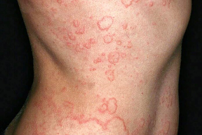 Urticaria crónica espontánea: lo que debe saber