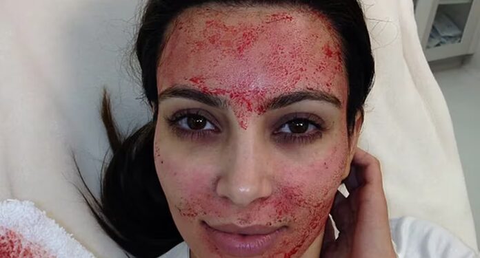 ¿Cómo son los “faciales vampiros” que se aplica Kim Kardashian, y por los que se registran tres casos de VIH?