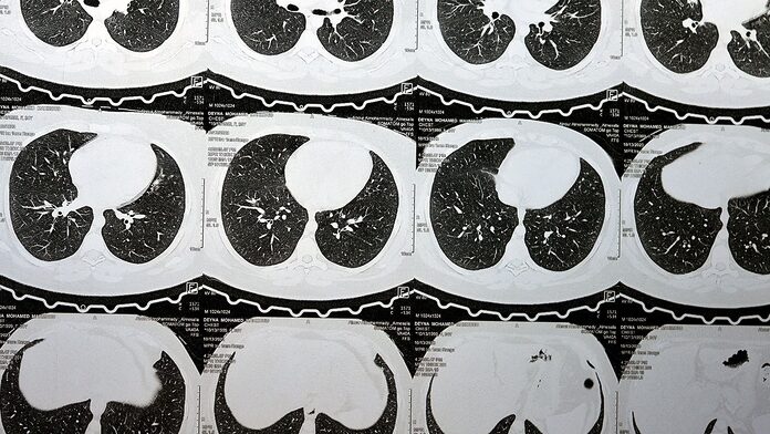 Anomalías pulmonares intersticiales progresivas relacionadas con dificultad respiratoria