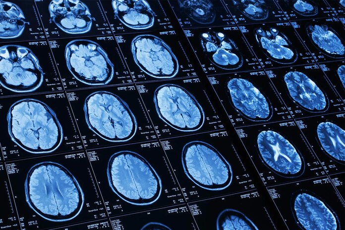 Riesgo de accidente cerebrovascular en estadounidenses de raza negra: preguntas y respuestas de expertos