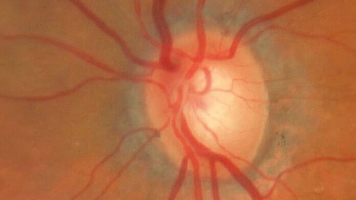 Glaucoma de ángulo abierto Dx: la puntuación de riesgo poligénico se considera útil