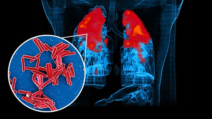 El tratamiento preventivo de la tuberculosis dirigido al riesgo funciona, en particular con pruebas de infección