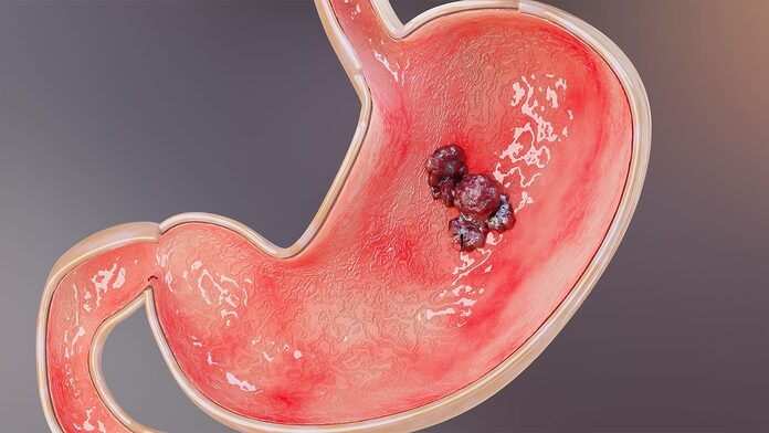 El mantenimiento prolongado con imatinib aumenta la supervivencia libre de enfermedad en GIST de alto riesgo