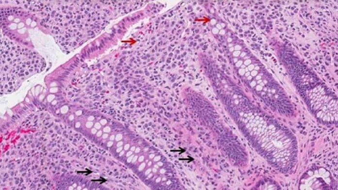 CDH1 vinculado con un nuevo síndrome de cáncer de mama hereditario