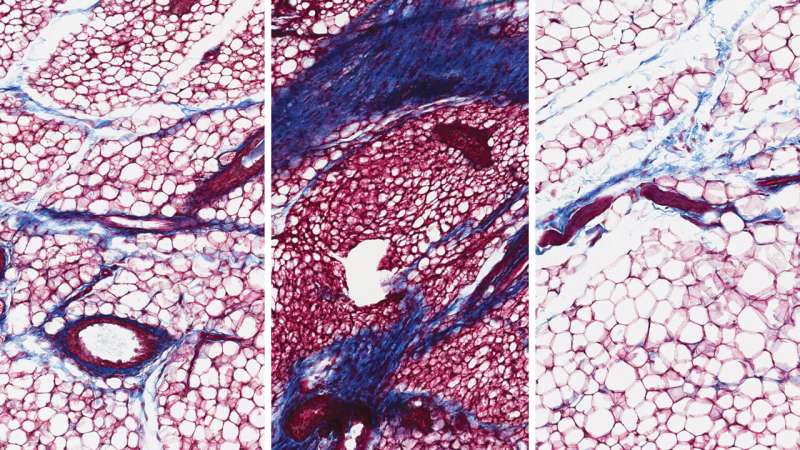 Un vínculo entre los cambios en los senos y… ¿las infecciones urinarias?