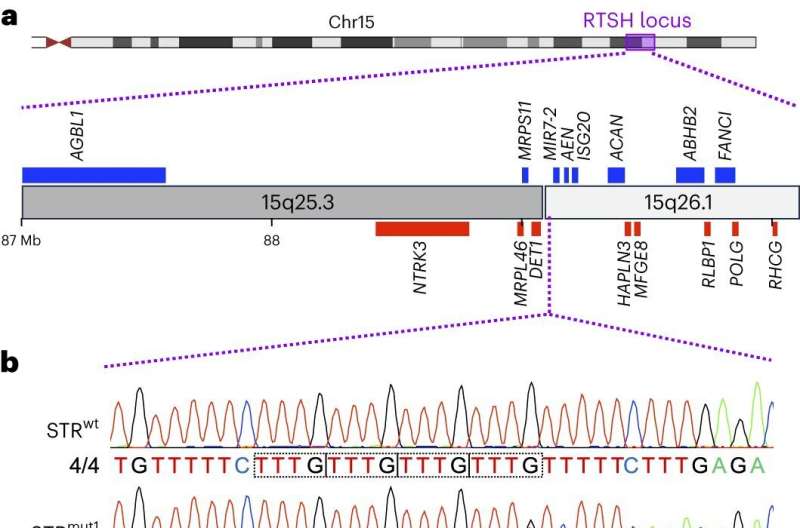 Nueva mutación genética identificada para una enfermedad congénita de la tiroides