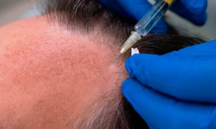 Innovaciones en el tratamiento de la alopecia: Medicamentos y avances recientes