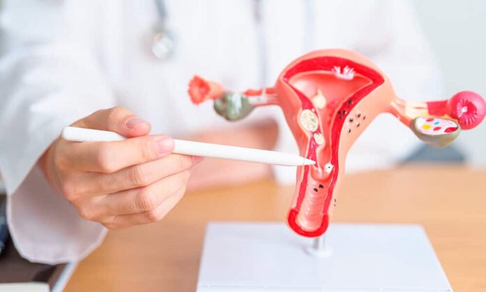 La endometriosis compleja afecta al 10% de las mujeres menstruales