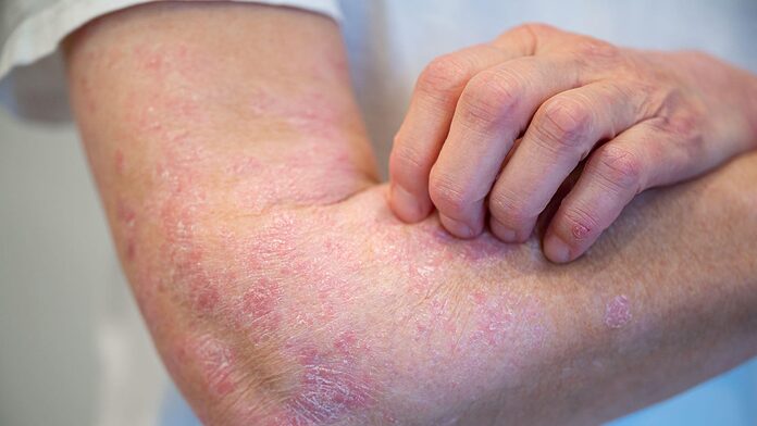 El control de la psoriasis se mantiene a largo plazo con un intervalo de dosificación prolongado de guselkumab