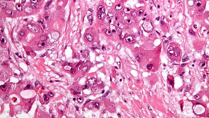 ¿Una nueva opción para tratar el carcinoma hepatocelular intermedio?