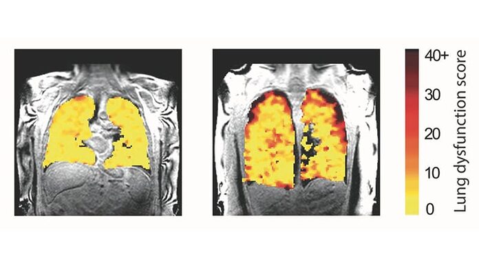 La resonancia magnética de pulmón usando inhalado puede detectar daños